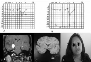 A - initial audio; B - final audio; C - MRI with a metastasis on the MAI; D - necropsy result; E - facial paralysis G V to the left.