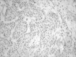 Immunohistochemistry-p53 - Cells dyed in brown show a positive reaction.