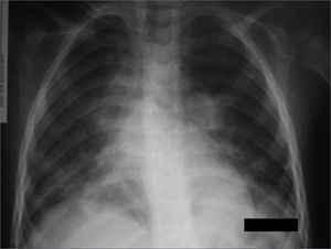 Chest X-Ray during respiratory dysfunction, showing the bilateral interstitial infiltrate.