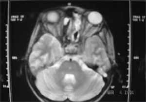 Soft tissue tumor occupying the left nasal cavity and invading the cavernous sinus.