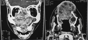 CT scan showing a large solid mass occupying part of the right-side maxillary sinus, palate and nasal cavity.