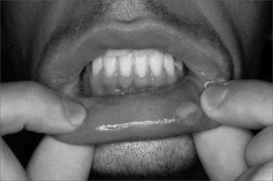 Aphthous lesion in oral mucosa of RAS patient.