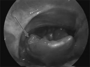 Atypical aphthous lesion in the lingual face of the right epiglottis.