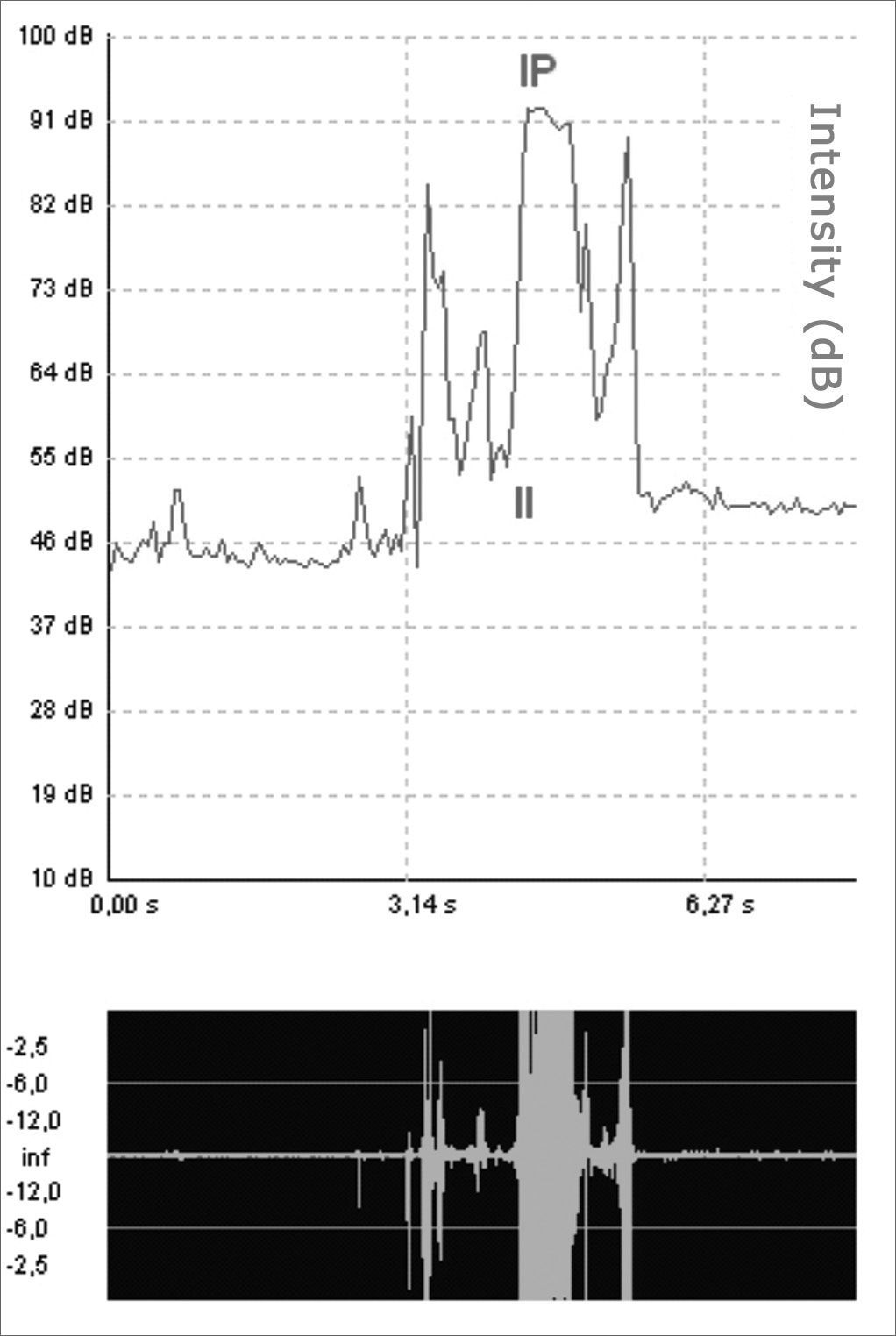 Sooning Intensifies Doppler sonar analysis of swallowing sounds in normal pediatric ...