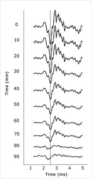 Tracing of animals in the intervention group showing progressive reductions in the amplitude of cochlear action potentials.