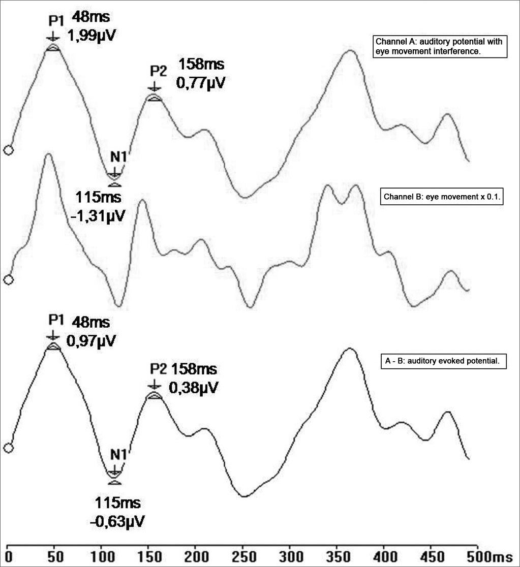 Protocol to collect late latency auditory evoked potentials | Brazilian ...