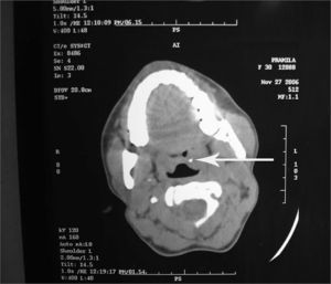 CT scan showing a small metallic density in left tonsil (arrow)
