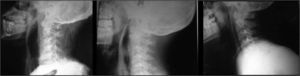 sequential lateral neck x-rays showing resolution of the abscess