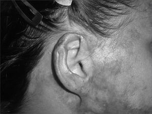 Skin flap with contralateral cartilage graft and 2 months after a second procedure with inferior condrocutaneous flap. Three-month final post-op.
