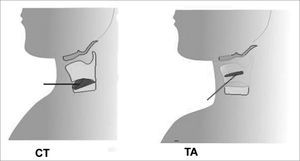 Electrode insertion in CT (cricothyroid) and TA (thyroarytenoid) muscles
