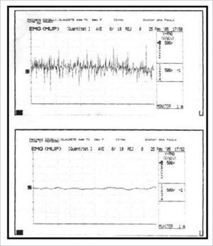 Normal laryngeal electromyography tracing during phonation (above) and rest (below).