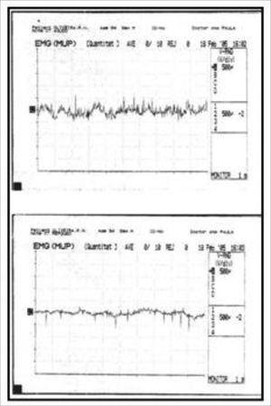 Altered laryngeal electromyography during voice rest (lower tracing): several action potentials (muscle activity) are seen.