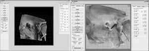 Computer screen image of virtual temporal bone dissection software. This German software may be downloaded free. Note well-defined textures and important anatomical structures, such as the facial nerve.