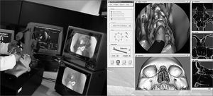 Virtual simulator of nasosinusal endoscopic surgery (ES3). Computer screen image of this software to the side. Note the possibility of changing virtually the tweezers, other tools, and dissection images.
