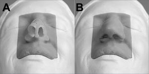 Rhinoplasty training model. A: model with exposed cartilage. B: model with synthetic skin covering cartilage. The white portion is a model of a fixed head. The skin-colored part is a module with synthetic skin and cartilage that may be dissected and touched.