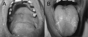 Initial presentation showing a white plaque on the palate mucosa (A) and the opposing lesion on the dorsum of the tongue (B). Note the similar contour of both lesions.
