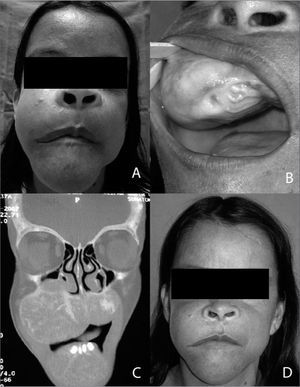 A: Facial asymmetry due to a brown tumor. B: Tumo extending to the palate. C: Coronal computed tomography de monstrating a tumor in the jaw bilaterally, D: Aspect of the fací after parathyroidectomy.