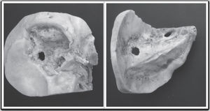 Human temporal bone after broad mastoidectomy.