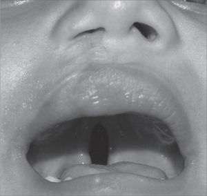 Patient with incomplete right-side cleft lip associated with incomplete cleft palate. Notice that the cleft lip has already been operated.