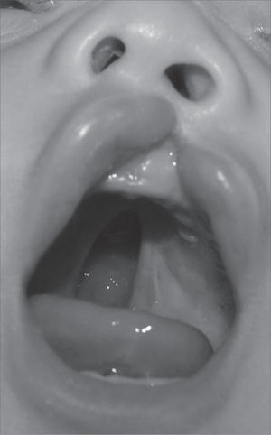 Patient with incomplete left-side cleft lip associated with incomplete cleft palate.