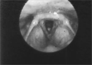 Vocal fold thickening with free border irregularities and interarytenoid edema.