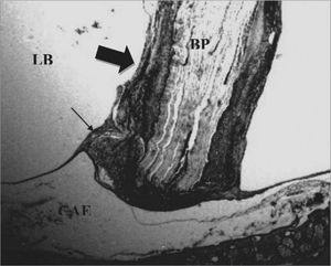Control Group. Microphotography of the fascia adhered to the tympanic bulla mucosa. LB= bulla lumen; OT = Temporal bone; thin arrow= fascia. HE (100x magnification).
