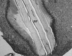 Experimental group at 8 weeks - Microphotography of the tympanic membrane, thickened at the point of contact; sugar cane biopolymer. Surrounded moderate subacute exudate; the biomaterial. BP= sugar cane biopolymer; LB= bulla lumen; CAE= external ear canal; thick arrow = inflammatory reaction; thin arrow =malleus. HE (40x magnification).