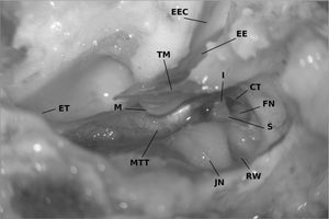 Lambs' middle ear anatomy (right ear) seen from the opened hypotympanon. The external ear canal (EEC) has been opened for measurements and exposes the epitympanal extend (EE) of the tympanic membrane. The tympanic membrane (TM) with the curved malleus' handle (M) can be seen. The tensor tympani muscle (MTT) inserts directly on the handle with the chorda tympani (CT) bending around. The stapes (S) is encircled by the facial nerve (FN) and connected to the long process of the incus (I). RW = round window, JN = Jacobsons' nerve, ET = Opening to the Eustachiian tube