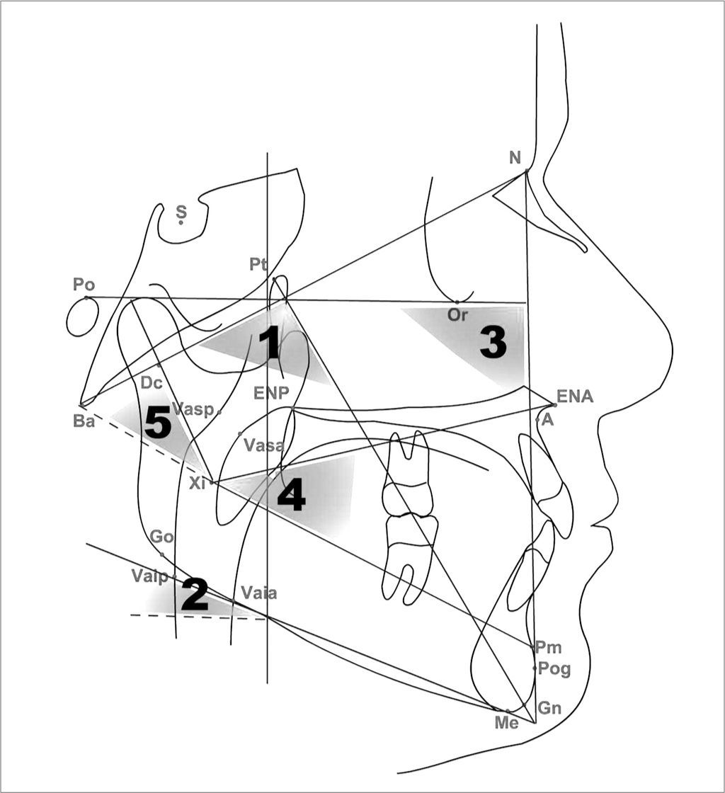 Is facial pattern a predisposing factor for otitis media with effusion ...