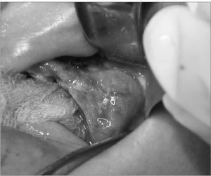 Surgical treatment of a maxillary central giant cell granuloma: case report - findings at surgery.