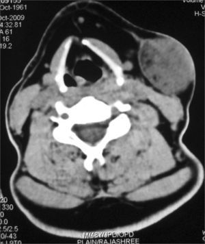 ct scan (axial) - ct scan showing a 3.2x4.2 cm soft tissue density with tiny densities of fat attenuation. lesion is seen displacing the platysma