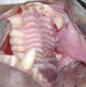 Exodontia of three upper premolars.