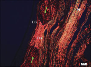 Histological section of an experimental surgical defect not completely filled in by bone (picro sirius red stained), under polarized light microscopy - surgical defect (DC) showing dense and parallel collagen bundles with red, orange, and yellow birefringent fibers, suggesting the presence of type I collagen; sinus epithelium (ES); periosteum (PE); bone ridges (green arrows).