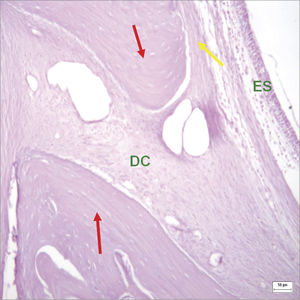 Histological section of an experimental surgical defect not completely filled with bone (hematoxylin-eosin stained) - bone riddges (red arrows); surgical defect (DC) containinig fibrous connective tissue; periosteium (yellow arrow); sinus epithelium (ES).