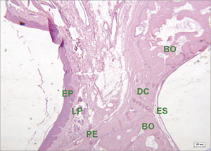 Histological section of an experimental surgical defect not completely filled with bone (hematoxylin-eosin stained) - surgical defect (DC) containing fibrous connective tissue; squamous epithelium (EP); lamina propria (LP); bone ridges (BO); periosteum (PE); sinus epithelium (ES).