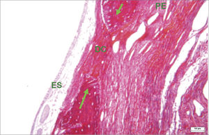 Histological section of an experimental surgical defect not completely filled in by bone (picro sirius red stained), under clear field microscopy - fibrous connective tissue in the surgical defect (DC), where red, orange, and yellow fibers predominate, suggesting type I collagen; sinus epithelium (ES); periosteum (PE); bone ridges (green arrows).