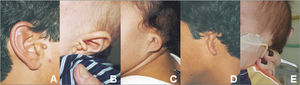 Images showing different grades of microtia in patients of the study sample: normal ear with preauricular appendage (A); grade I microtia with preauricular appendages (B); grade II microtia (C); grade Iii microtia (D), grade IV microtia or anotia (E).
