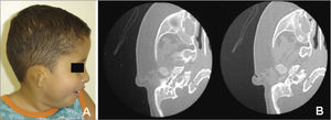 OAVS patient from the study sample (number 12 in Table 1) - the computed tomography of the mastoid showing right ear anomalies (opacified middle ear and malformed ossicular chain).