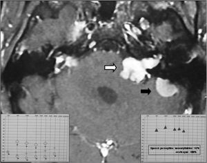 Magnetic resonance imaging (T1 contrast) showing a vestibular schwannoma to the left (white arrow) associated with a meningioma on the medial aspect of the left petrous bone (black arrow). Note also small manipulation remains in the right pontocerebellar angle. On the lower left detail, see preoperative audiometry. On the lower right detail see audiometry 6 months after the cochlear implant.