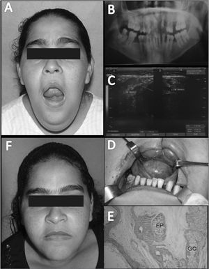 Dermoid cyst - A. Bilaterally enlarged submentual and submandibular mass resulting in a double chin, limited opening of the mouth, and elevated floor of the mouth; B. Panoramic radiograph of the jaws; C. Ultrasound - arrows show a suggested cyst with a semiliquid content within the fascial spaces of the muscles in the floor of the mouth; D. Surgical removal of the lesion through an intraoral approach; E. Histopathology. Note the wall of the cyst consisting of fibrous connective tissue, skin elements such as a hair follicle (PF), and sweat glands (SG) (H.E. 100x); F. Postoperative aspect after 1 year and 6 months.