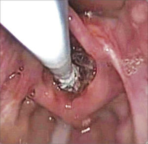 Direct laryngoscopy with a zero degree scope, showing the catheter being introduced in the larynx, with the balloon completely deflated