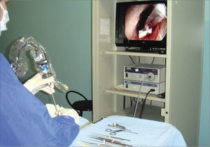 Position in the operating room. The ENT surgeon performs the procedure looking directly at the monitor in front. The instruments must be positioned at easy access, such as on this table next to the surgeon.
