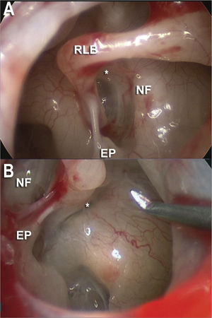 30 degree scope endoscopic view of the oval window niche. A: facial nerve canal (NF), long process of the incus (RLB), pyramidal eminence (EP) with its tendon and its anterior and posterior crura (*). B: In another case we noticed the same endoscopic view with the 30 degree scope.