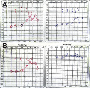 Fax of the audiogram belonging to the patient submitted to left ear fully endoscopic stapes surgery. A: preoperative test showing the conductive-type curve bilaterally. B: post-op test showing the conductive hearing loss in the right ear and within normal ranges in the left ear.