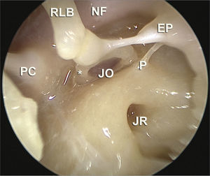 Endoscopic image of the anatomical dissection after removal of the ear drum, with a 30 degree scope, showing the type of image which can be achieved by means of endoscopic approaches. Here we see the niches of the round and oval windows (JR and JO, respectively), pyramidal eminence (EP), ponticulus (P), facial nerve canal (NF), long process of the incus (RLB) and incus-stapes joint; also the cochleariform process (PC) and practically the entire posterior tympanic sinus.