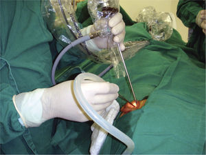 Figure showing how the endoscope is positioned inside the external auditory canal, as well as hand position - one holding the endoscope and the other holding the instruments. Notice that the hands are in different horizontal planes.