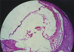 Total absence of the Organ of Corti in the middle cochlear turn of the guinea pigs injected with cisplatin at the dose of 3mg/kg for six consecutive days. 40x magnification. MV – Vestibular Membrane; EV – Stria Vascularis; OC – Organ of Corti.