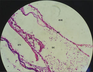 Extensive loss of the normal microarchitecture of the organ of Corti, outer and inner hair cells without definition. No tectorial membrane in a guinea pig treated with cisplatin at the dose of 3mg/kg for six consecutive days. 40x magnification. MV – Vestibular Membrane; EVE – Scala Vestibuli; ETI – Scala Tympani; DC – Cochlear Duct; OC – Organ of Corti.
