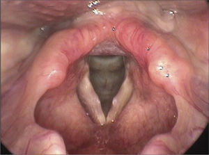 Bilateral vocal nodules.