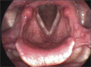 Right vocal fold cyst.